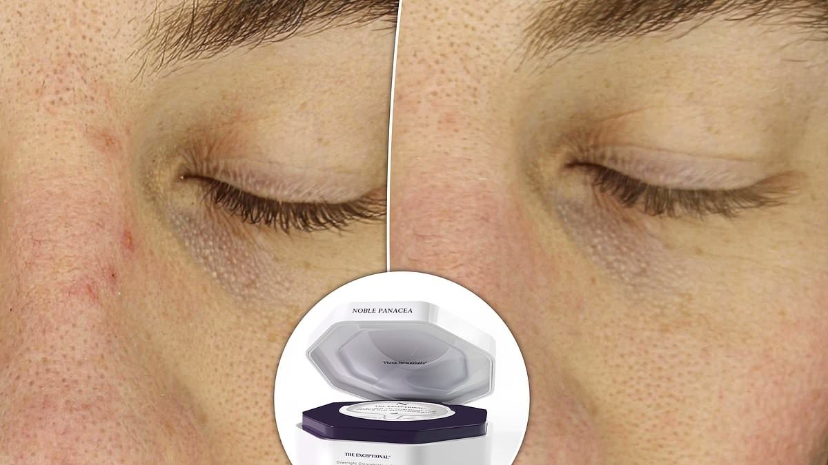Nobel Prize-winning chemist develops at-home peel that fades scars and pigmentation (and in as little as four uses)