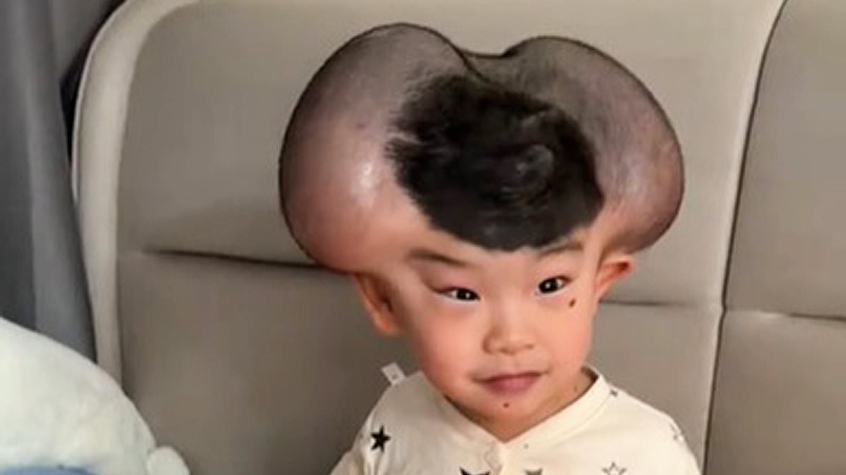 Parents of boy cruelly nicknamed 'Mickey Mouse' over giant growths caused by treatment for rare skin condition share their joy as he makes amazing transformation