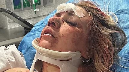 EXCLUSIVE Astonishing wedding day transformation of bride who was beaten bloody in brutal bachelorette party attack