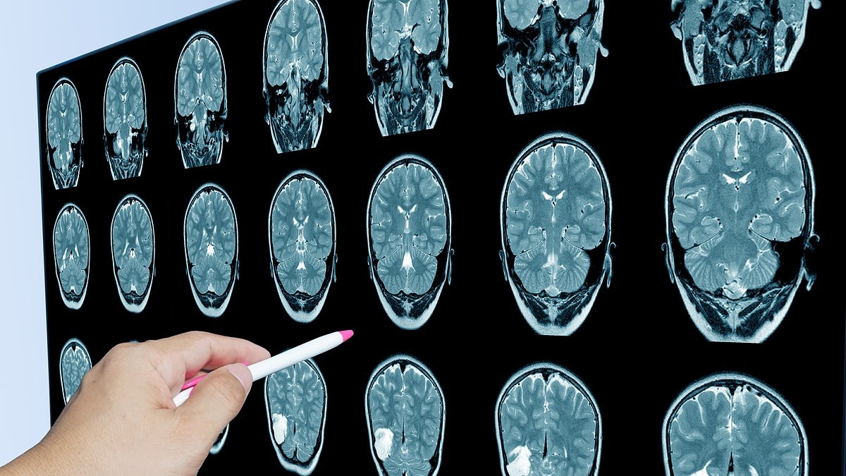 Scientists discover toxic substance hiding in 100% of people's brains... and 'it explains rise of dementia in US'