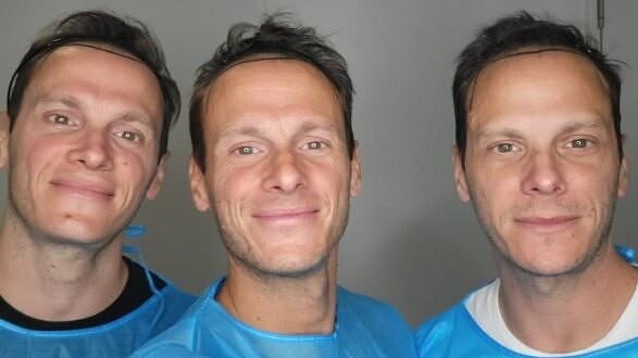 Identical triplets who went bald at the same time undergo dramatic hair transformation thanks to 'the only treatment that really works'