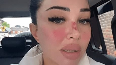 Tulisa shows off her bloodied nose and swollen face as she enjoys SIX beauty treatments to keep her 'eyebrows and cheeks' pert