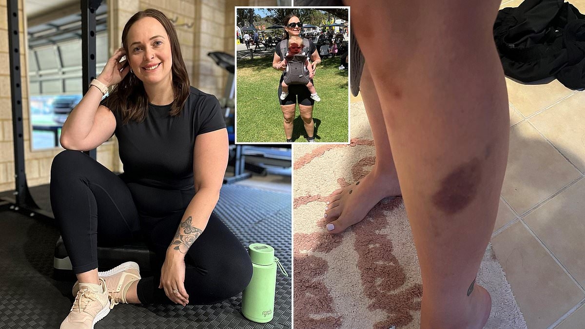 Young Aussie nurse is handed shock diagnosis at 30 after bruising on her legs for years - and one in nine women are at risk