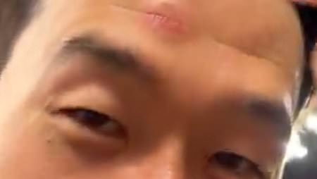 Tottenham captain Son Heung-min left with battle scar following freak injury during Europa League final celebrations