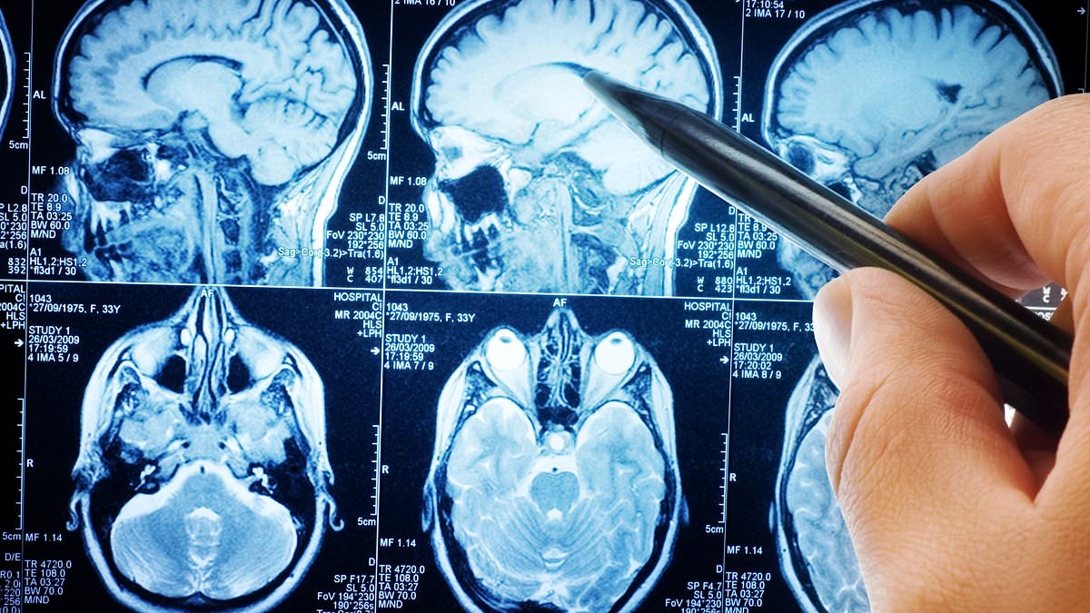 You can spot Alzheimer's YEARS before symptoms appear with groundbreaking new scan...would YOU have it?