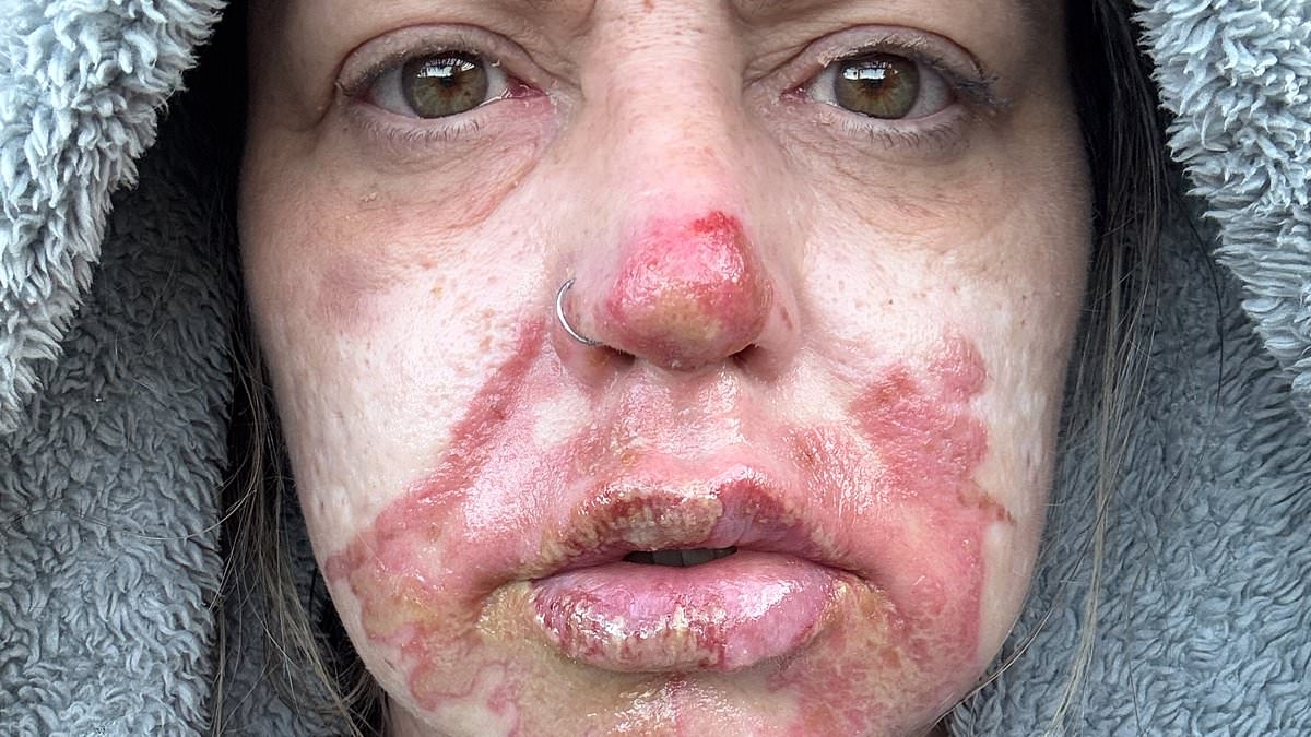 Mother, 52, is left with agonising second-degree burns after tealight exploded in her face
