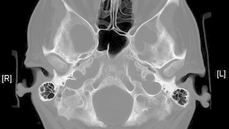 Drunk man impales EYE after falling face-first on to ornament – narrowly missing his brain