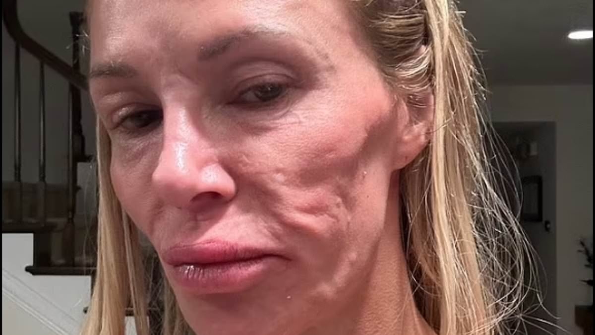 Brandi Glanville reveals shocking impact of her disfigured face on her sex life