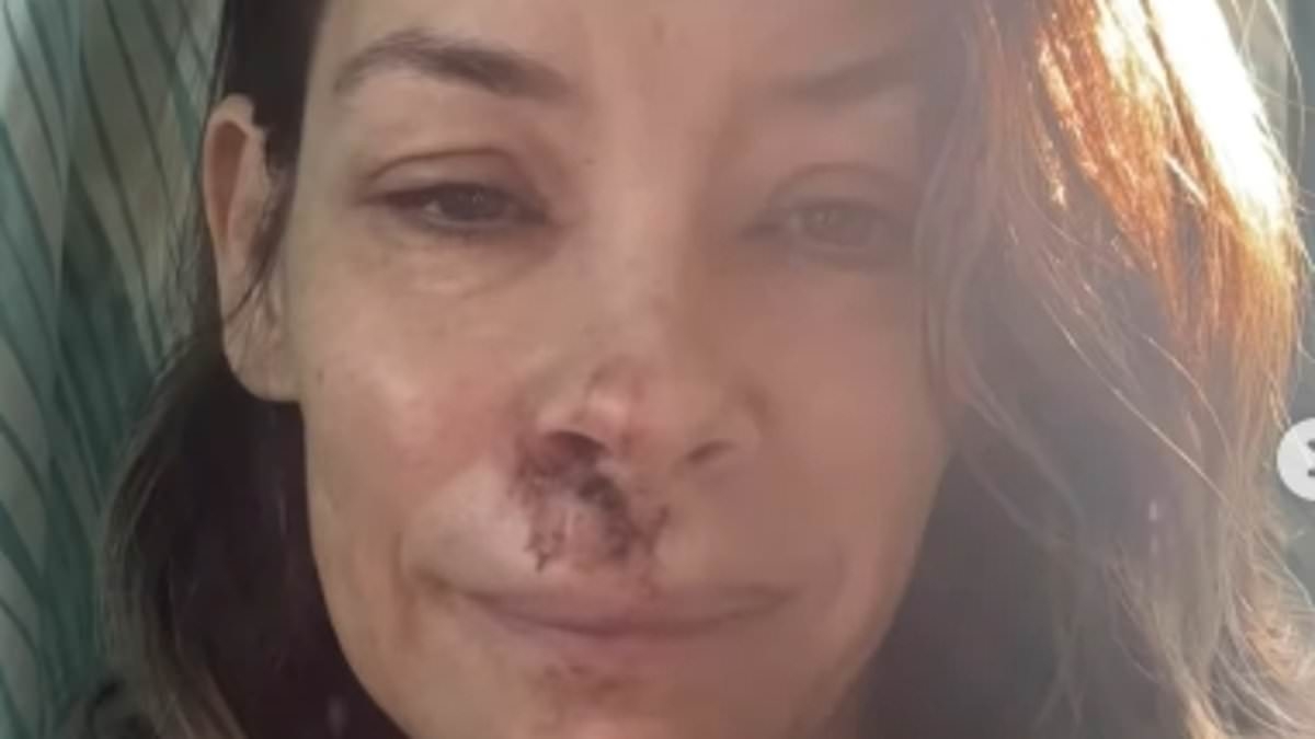 Evangeline Lilly, 45, shares shocking photos of her facial injuries after horror fall at the beach