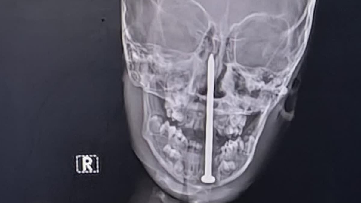 Seven-year-old boy has three-inch nail removed from his BRAIN by incredible surgeons after he fell on it in horrific India playtime accident