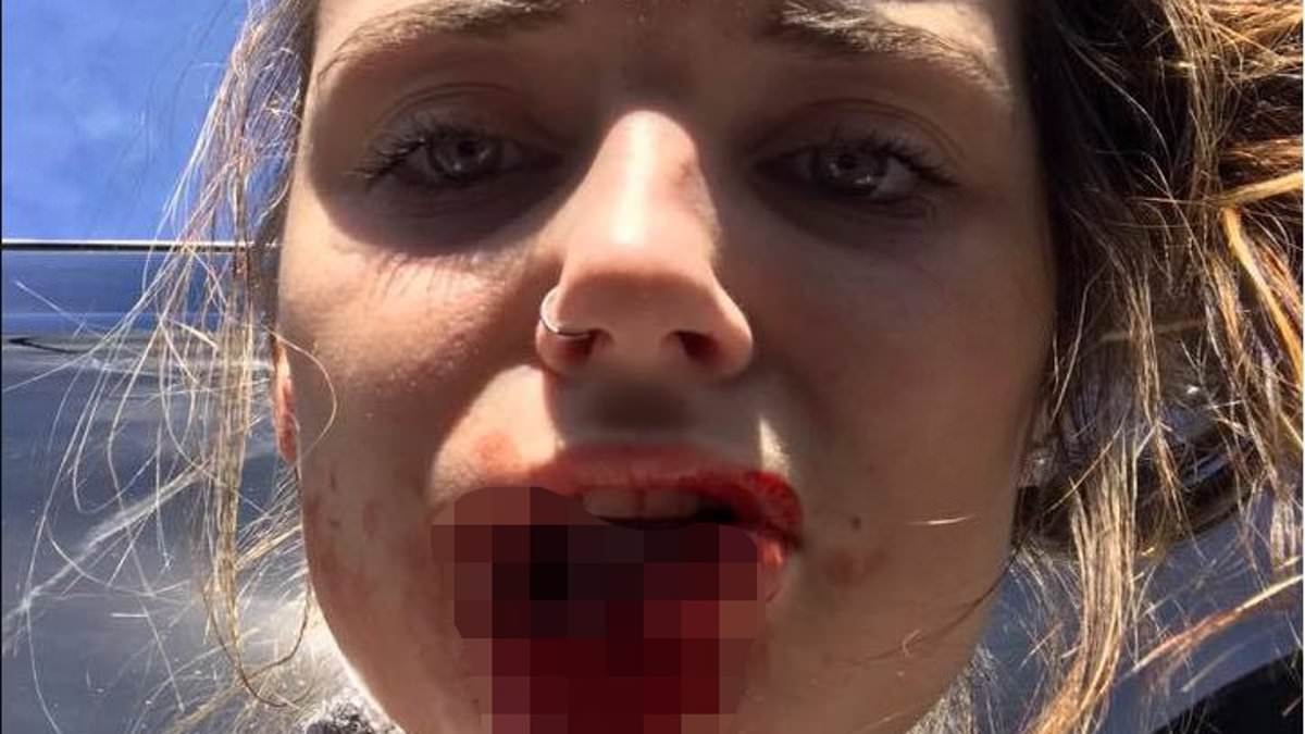 Woman whose entire lip was bitten off by her violent ex boyfriend reveals what she looks like seven years after brutal attack