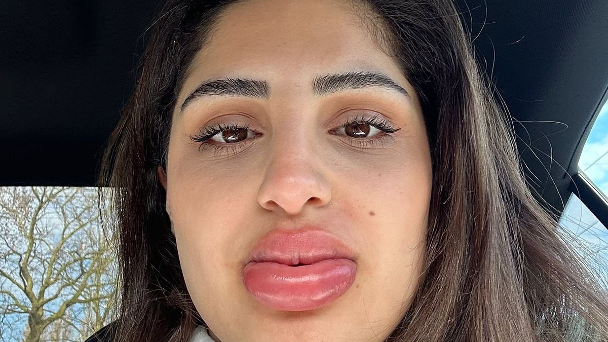 Horrific reaction to popular cosmetic tweak leaves woman, 24, looking like a Bratz doll