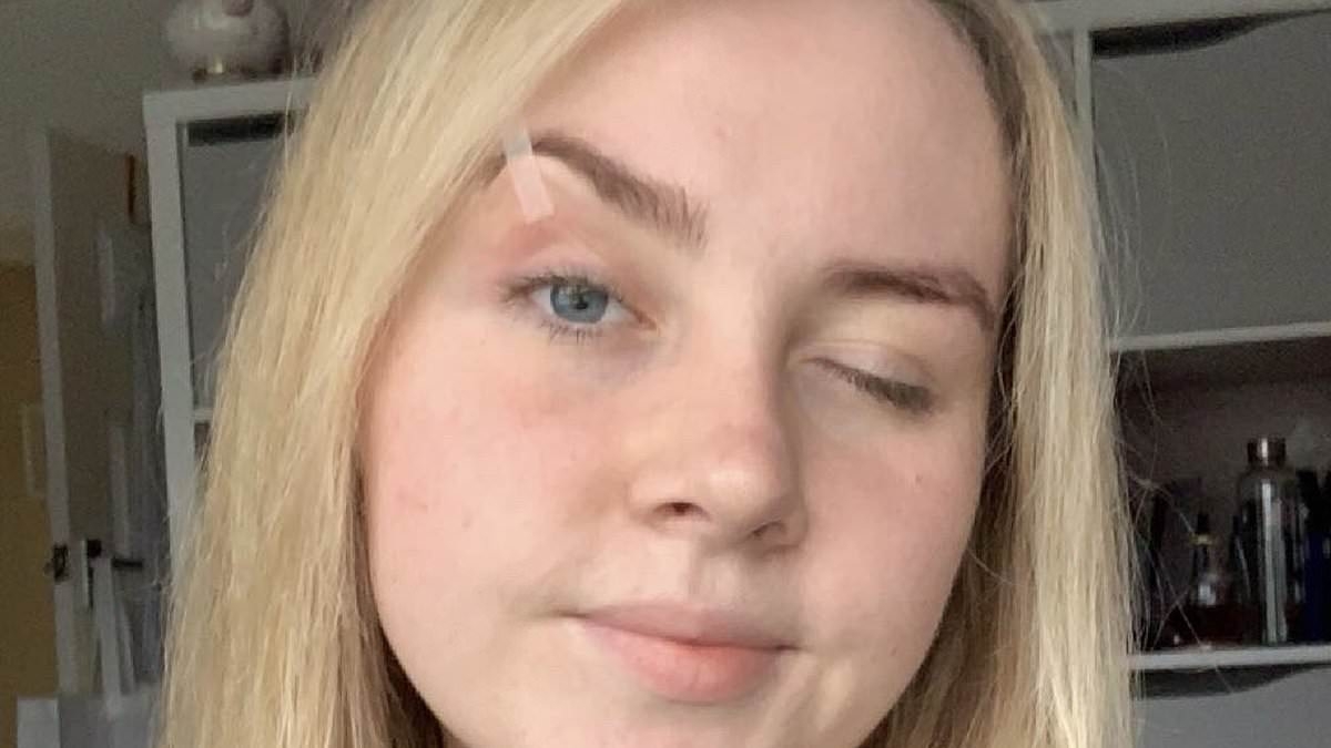 Woman, 21, forced to 'glue eyelids open' just so she can see due to rare condition - but doctors say there's no cure
