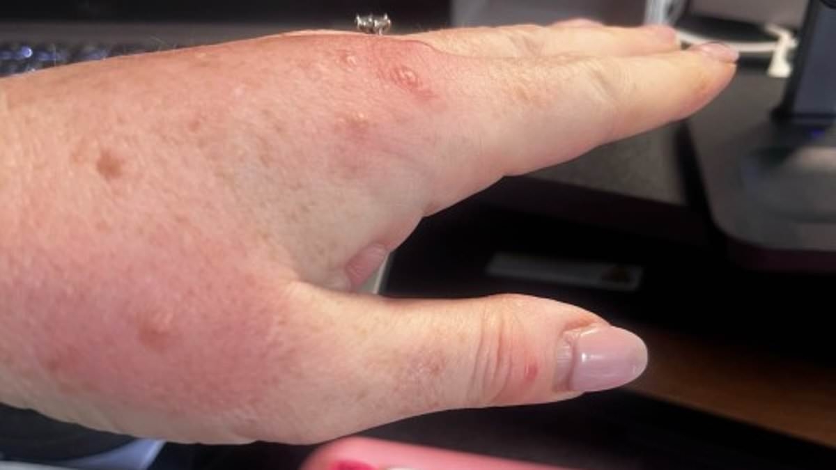 EXCLUSIVE Hotel guest who was bitten 30 times by bed bugs in infested room tells how she woke up to see them 'crawling on the bed'