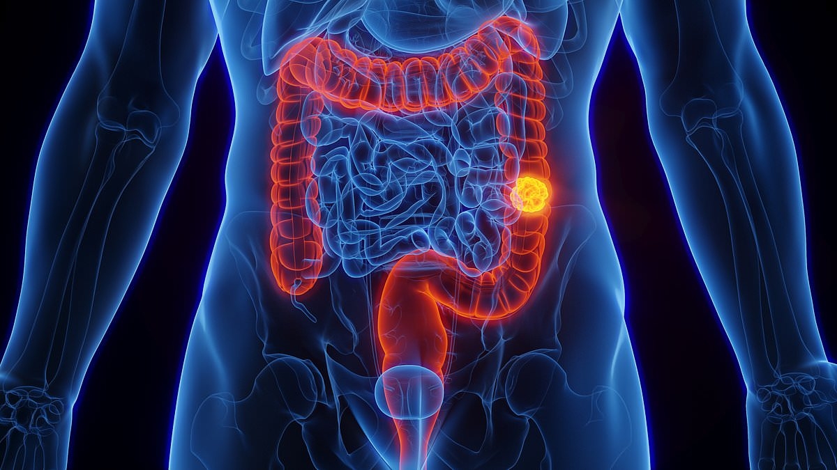 Revealed: The 20-minute routine developed by doctors that may help PREVENT bowel cancer as cases continue to surge