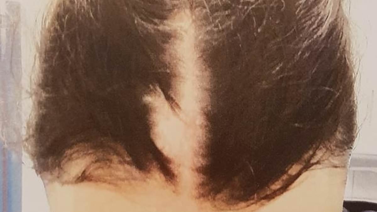 Pregnant cop who had clumps of hair ripped from her scalp by a notorious anti-vaxxer breaks her silence