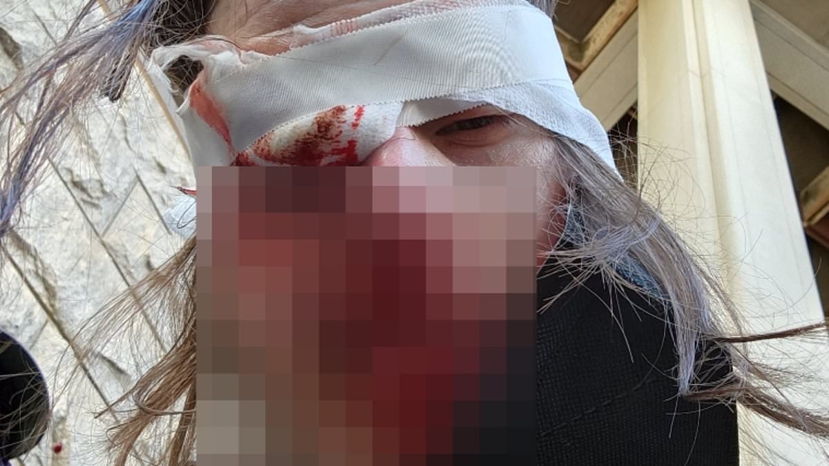 Anti-Trump protester fears he may go blind after police opened fire with rubber bullets at rally