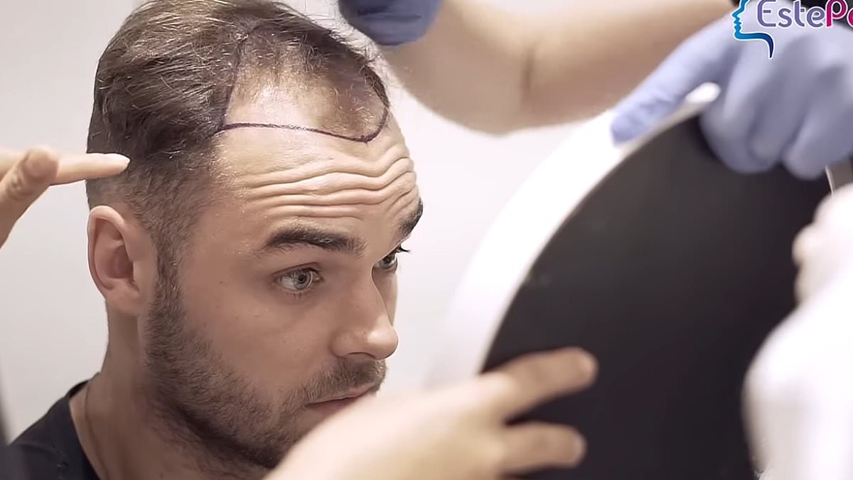 Love Island stars Harry Cooksley and Ben Holbrough look unrecognisable in unveiled hair transplant videos prior to their time in the villa