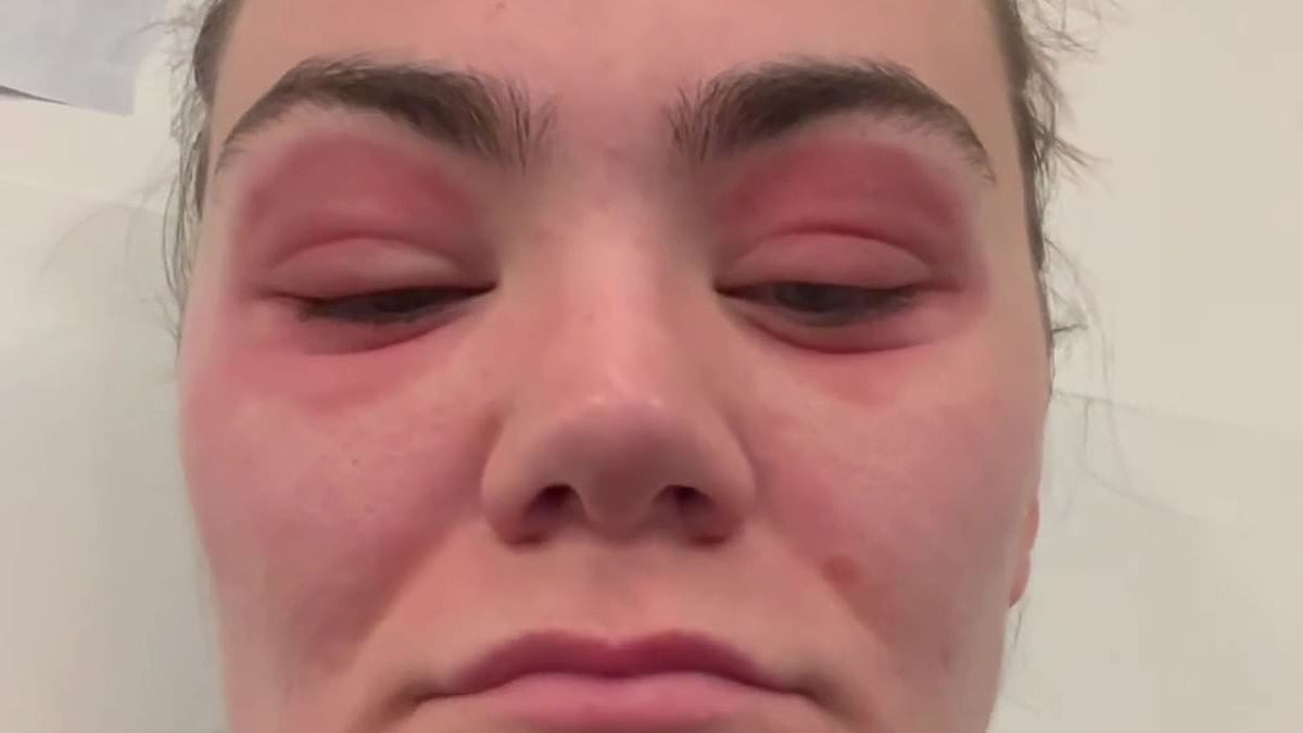 Woman hospitalised with 'bulging' eyes after using cult bargain beauty product
