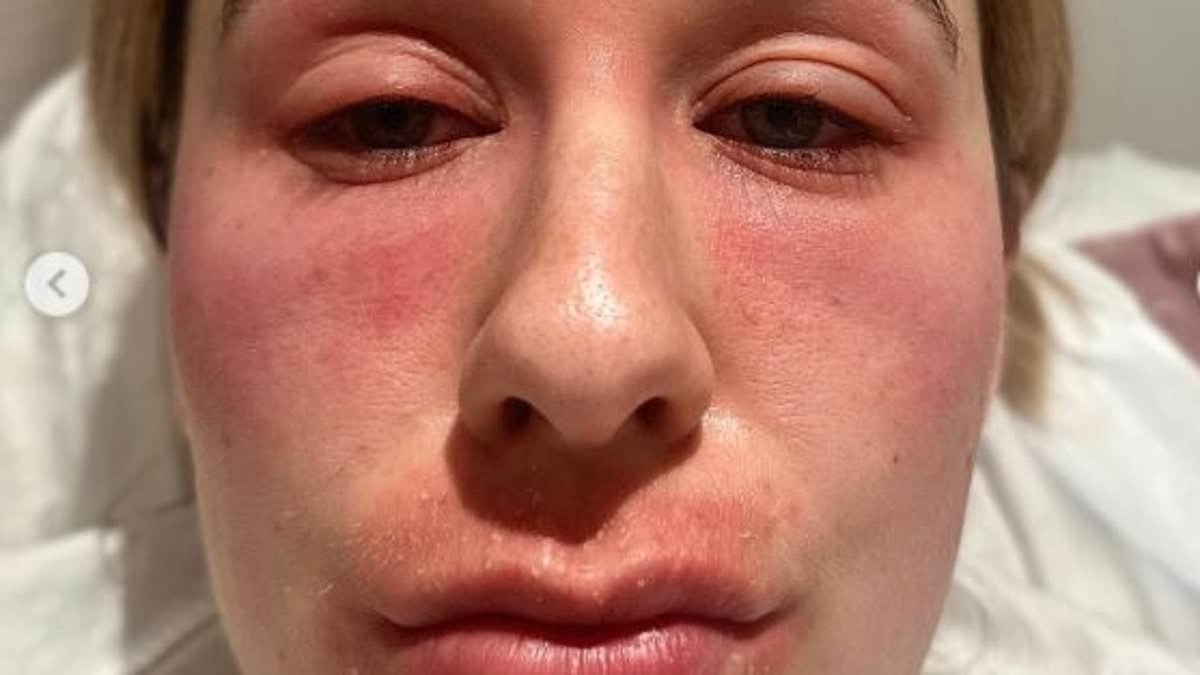 Cruel eczema makes my face swell up and covers my body in a raw rash. Then I discovered the game-changing ways to control it - and now my skin looks like THIS