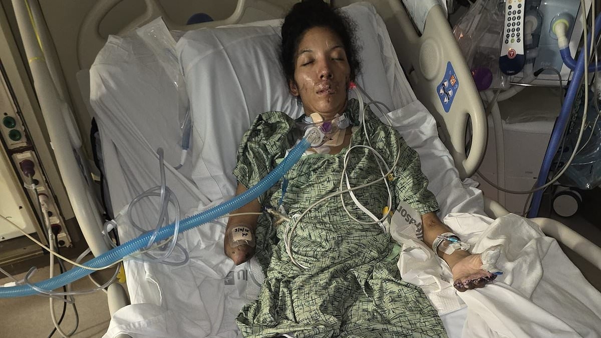 Terrified mom wakes up with all of her limbs amputated after catching two common infections at the same time