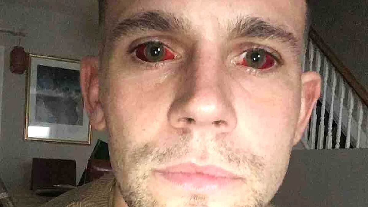 Man was left in coma with 'devil eyes' after five-day cocaine-fuelled session that almost killed him