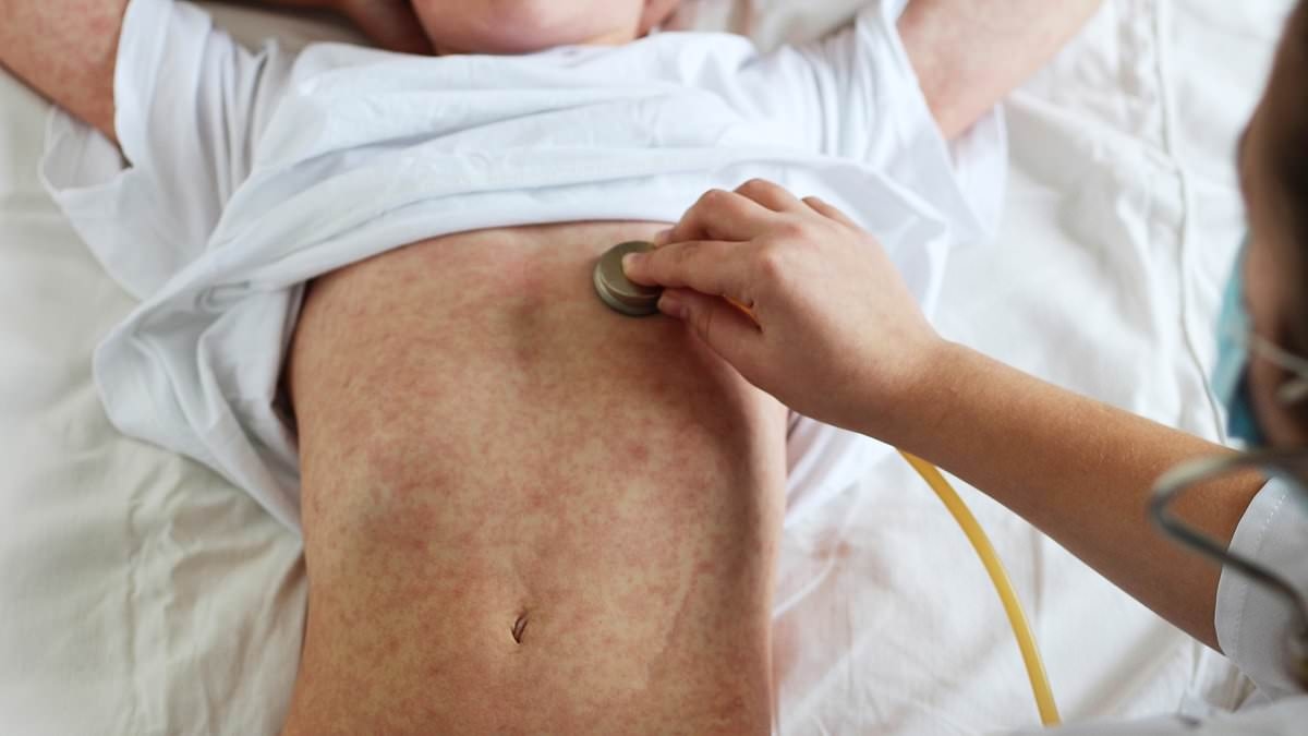 Surprising jab-dodging area where HALF of children aren't vaccinated against measles...as cases surge across UK