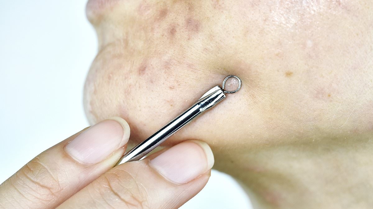 Top dermatologist's urgent warning to those with spots - common remedy could leave you scarred for life