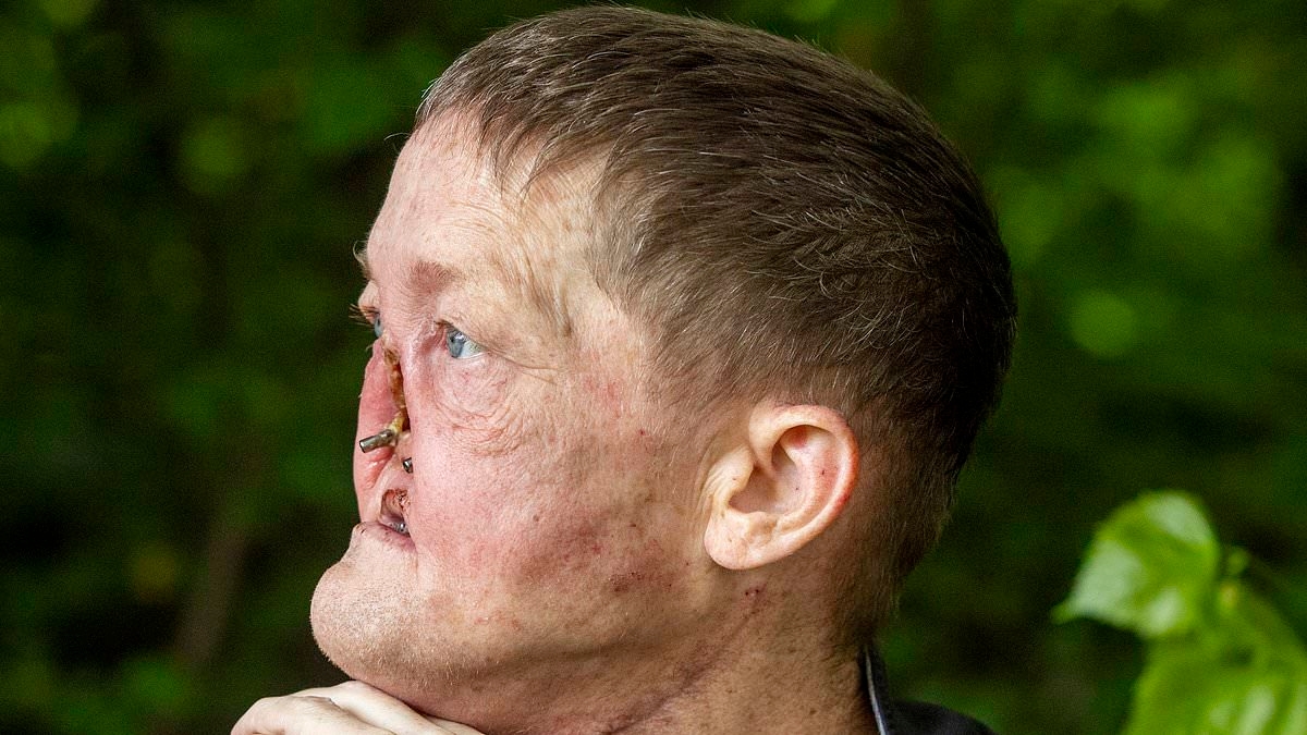 Man suffers 'infection' that affects us all - it was actually killer cancer that cost him his NOSE