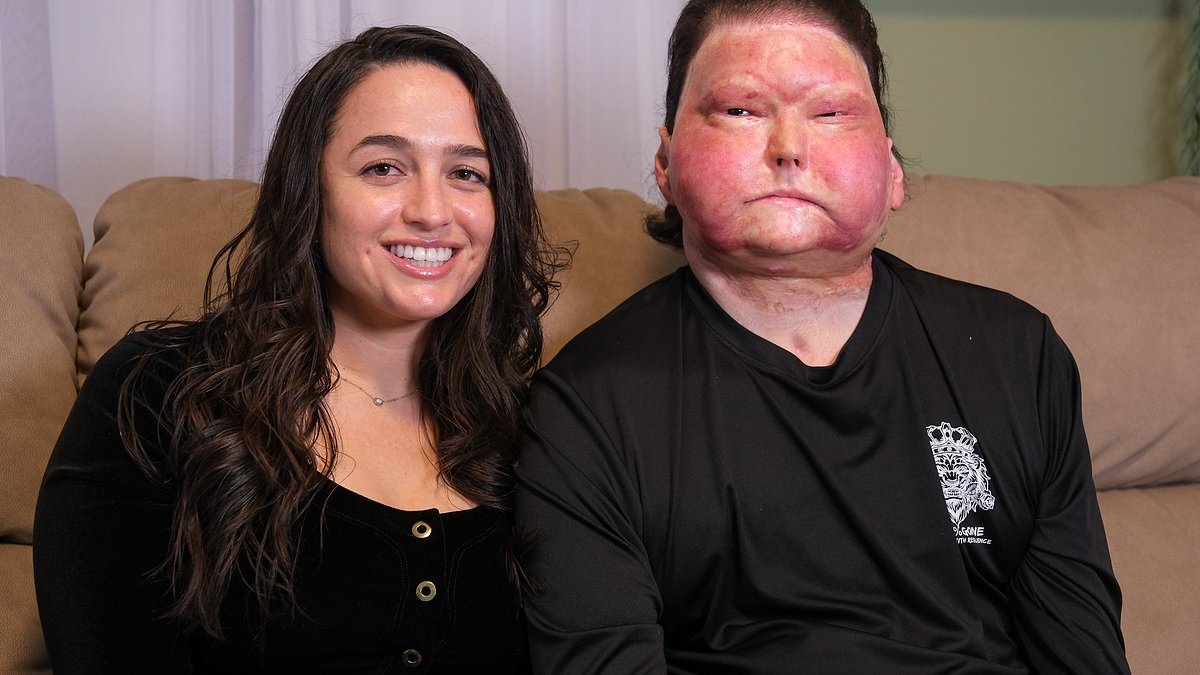 Car crash victim, 26, who received face transplant from 47-year-old man reveals what he heard while in a coma