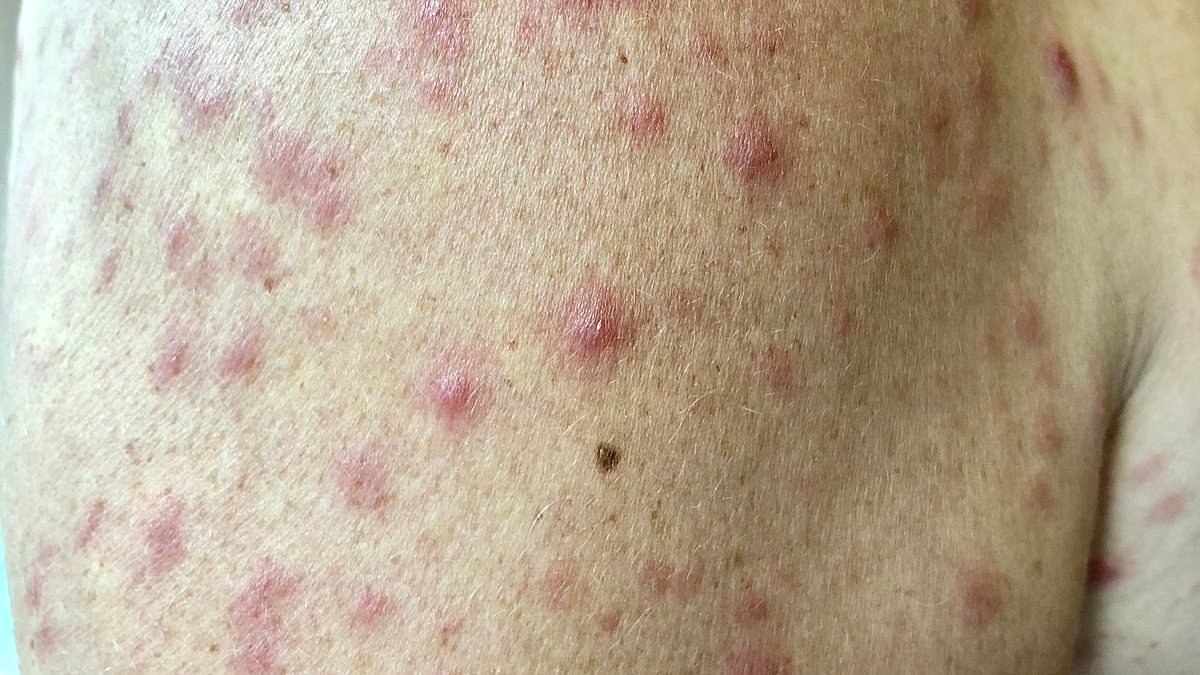 Urgent warning for residents in the Northern Territory as cases of sexually transmitted infection explode