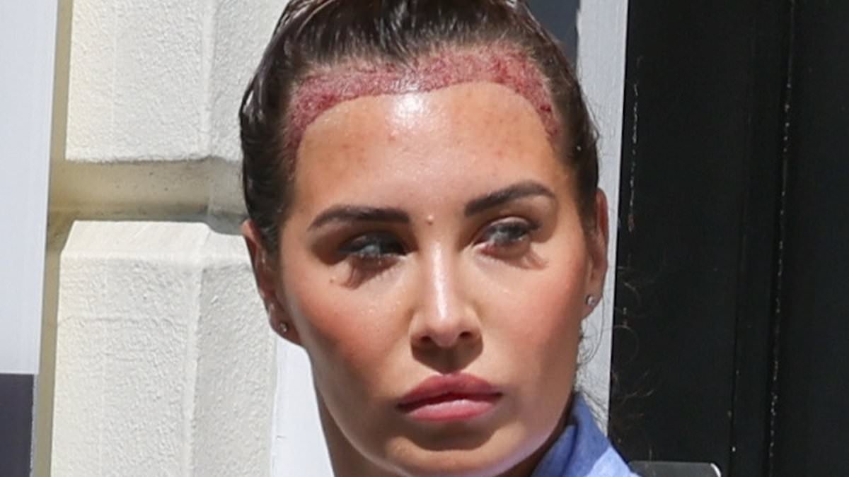 Chloe Goodman shows shocking results of hair transplant as star is seen leaving the clinic post procedure