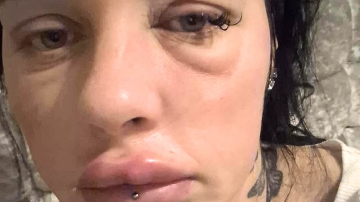 Mother left looking like a 'horror movie villain' with oozing lips and a swollen face after going 'crazy' with filler