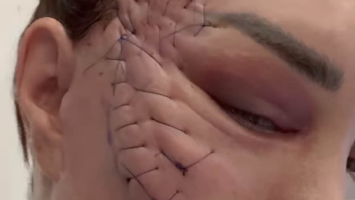 Rise of patchwork facelift techniques that leave patients with eye-watering stitches - as surgeons say painful-looking method heals FASTER