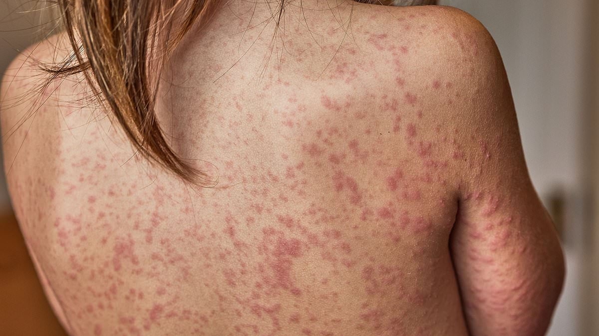 Child dies of measles in Liverpool fueling warnings virus could spread like 'wildfire' amid plunging vaccine rates