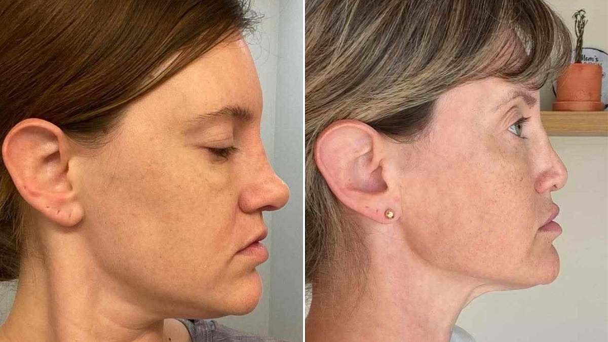 EXCLUSIVE I spent $10K on a nose job...and woke up with part of my face missing