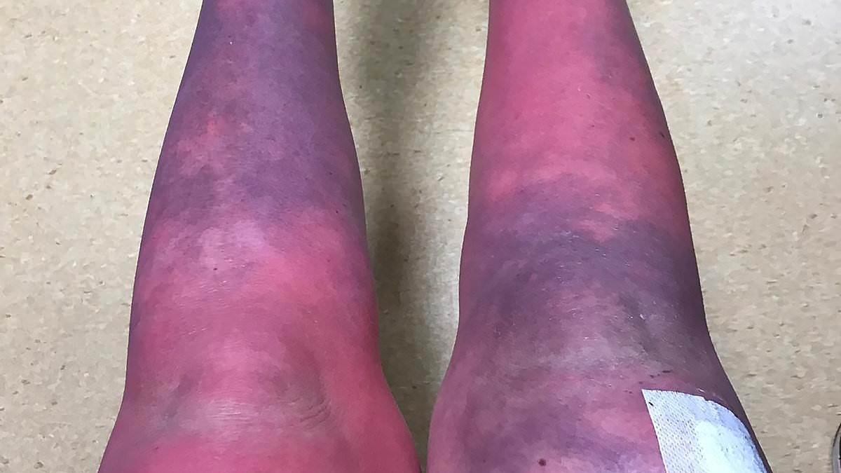 Woman, 30, left in agony after developing rare condition which makes her feel like she's been set on fire