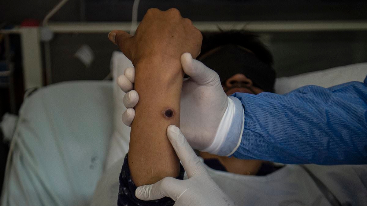 Rare strain of disease confirmed in Australia for just the second time