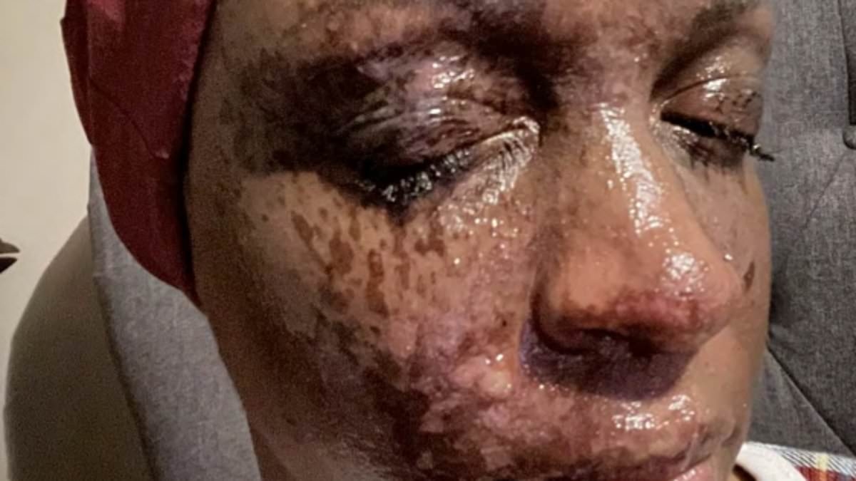 Woman's face melted off after Bath & Body Works candle explodes, lawsuit claims