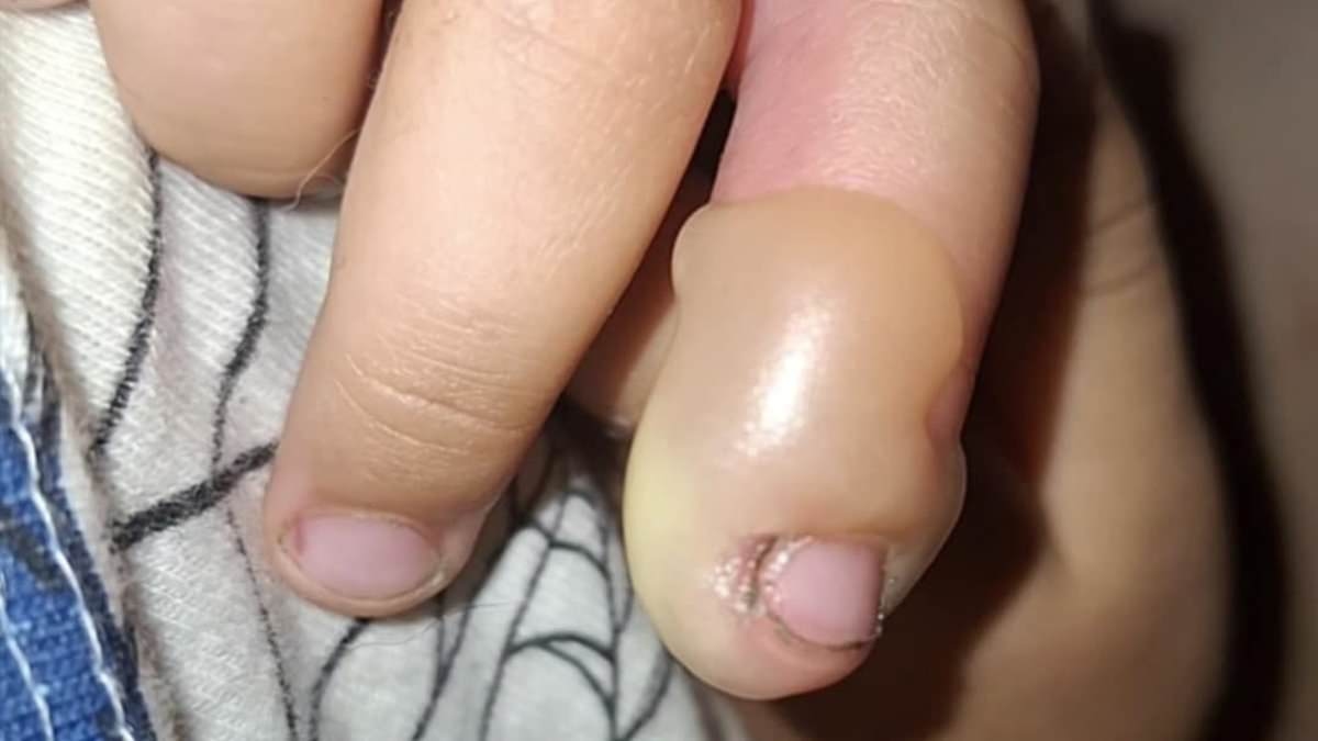 Britain's 'most dangerous plant' strikes in Newcastle: Toddler is left with a blister the size of a PLUM after brushing past giant hogweed