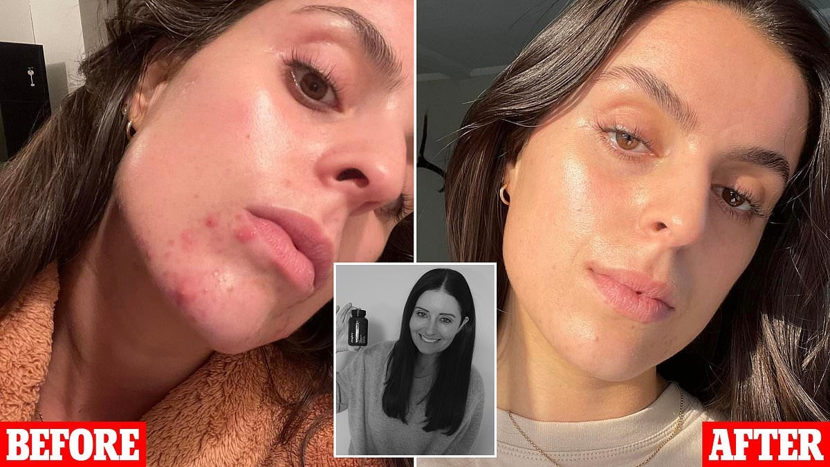I tried a 'magic' buy for hormonal acne, hair loss and post-pill breakouts - now I need all women to know about it