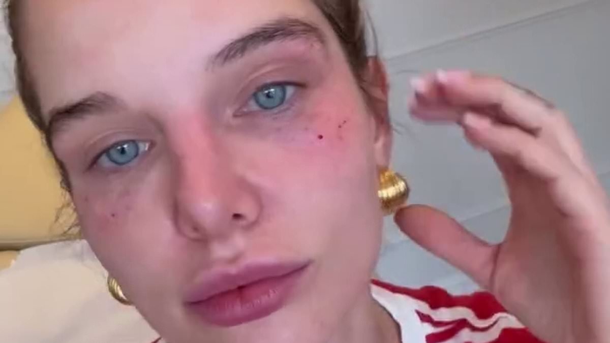 Helen Flanagan, 34, sports painful looking black eye after undergoing £400 cosmetic injections