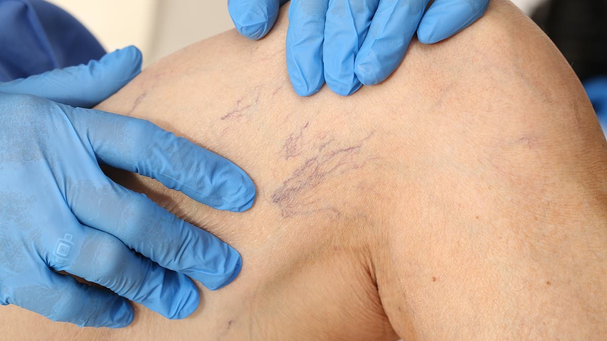 I hate the ugly veins in my legs... is there a way to get rid of them? DR ELLIE reveals the treatments available – and the simple seating position that can help