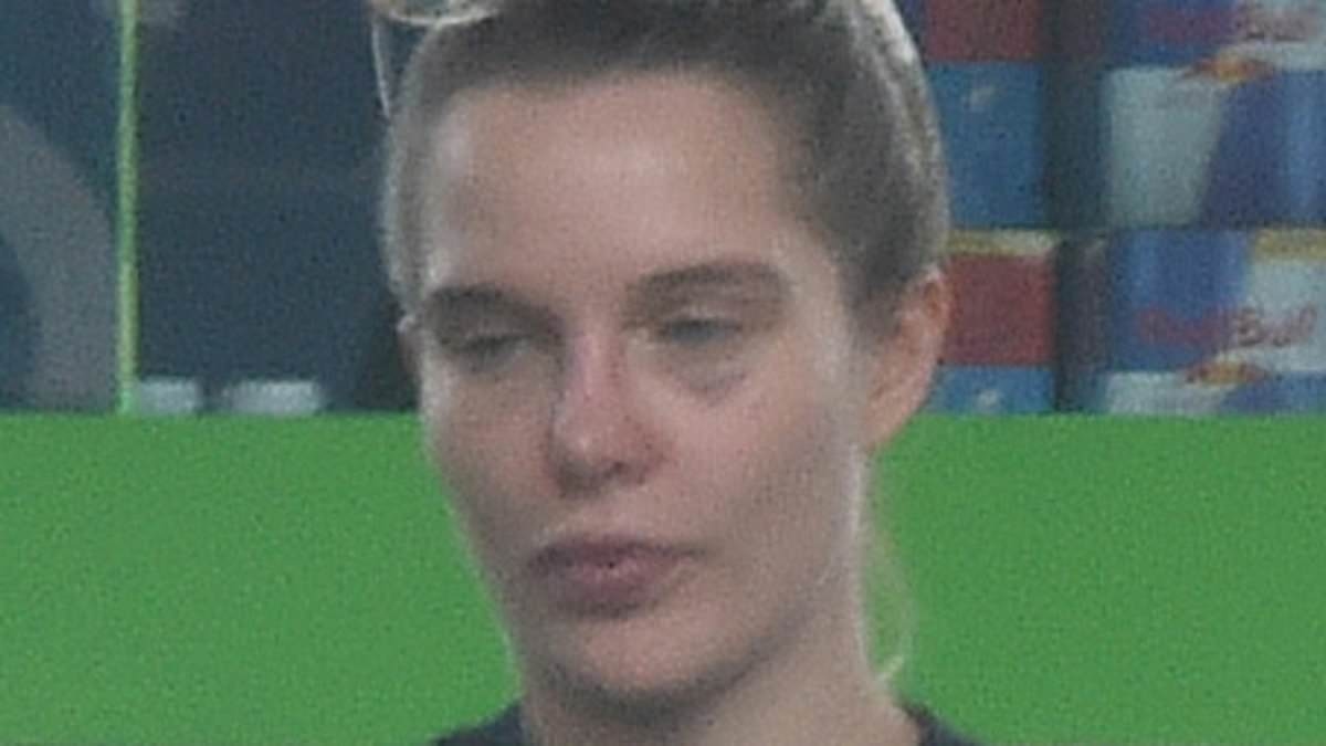 Helen Flanagan displays her painful-looking black eyes as she fills up her £66,000 Audi with petrol after undergoing £400 skin injections
