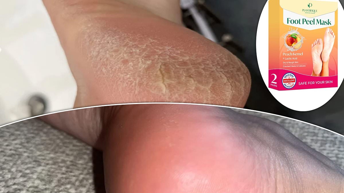 The foot peel mask that has all of TikTok raving about the 'GROSSLY satisfying' results is on sale for under £16 at Amazon