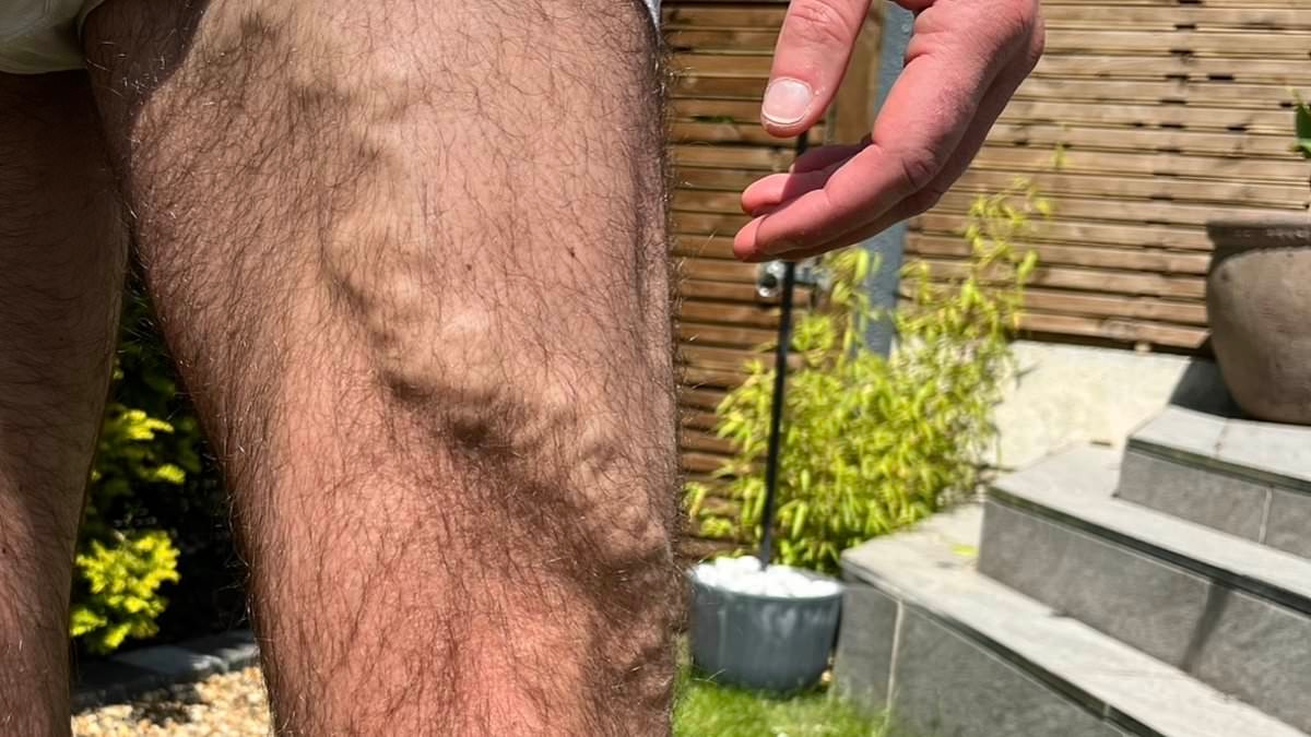 What CAN I do about the ugly, lumpy veins in my legs? Top surgeon reveals the treatments that actually work... and the one to avoid