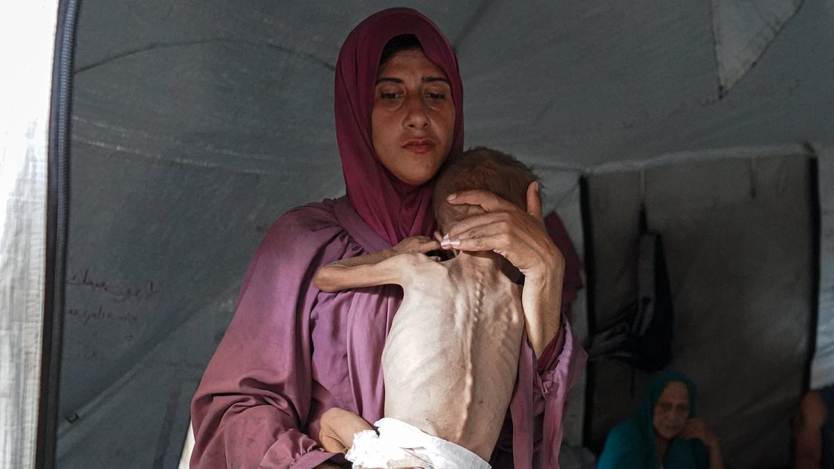 Experts describe the slow and agonizing symptoms of starvation, as Melania joins President Trump to decry the plight of Gaza children