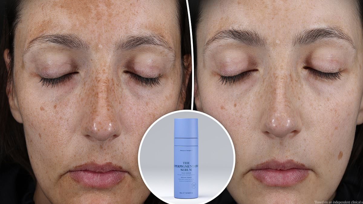 The ‘magic' pigmentation serum that sold every two MINUTES on launch day is finally back in stock - and it transforms skin in weeks