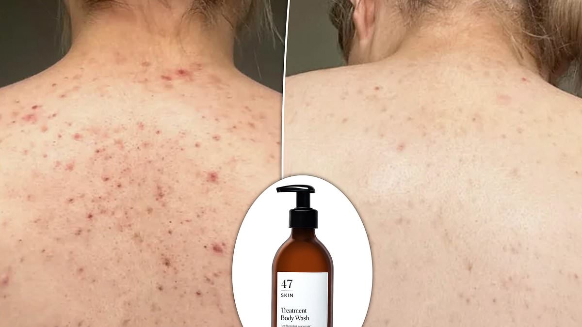 The dermatologist-approved 'magic' body wash wowing shoppers by clearing back and chest spots FAST: 'This product is incredible'