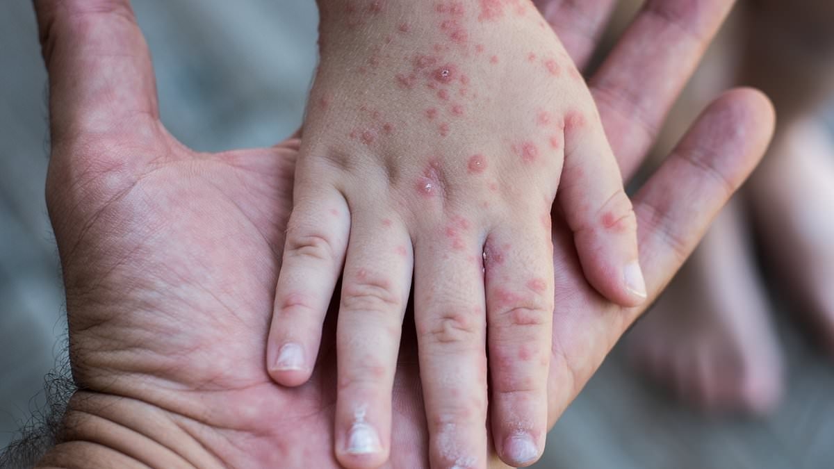 New York City preparing for outbreak of SECOND 'highly contagious' virus... as cases spread to neighboring states